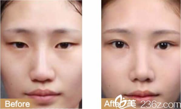 于璇雙眼皮前后對比案例 于璇雙眼皮前后對比案例