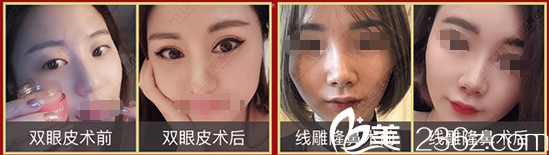 成都美萊美整形美容醫(yī)院眼、鼻整形案例