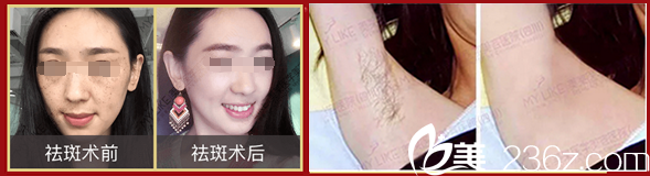 成都美萊美整形美容醫(yī)院祛斑、脫毛案例