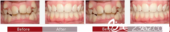 成都美萊美整形美容醫(yī)院牙齒矯正案例