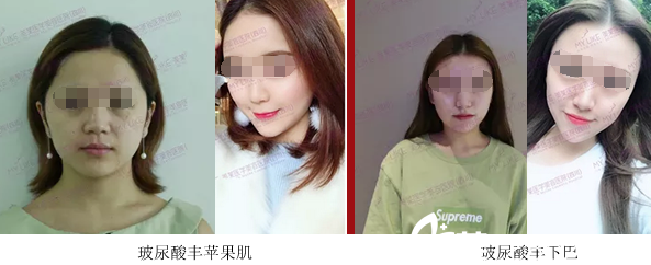 成都美萊玻尿酸豐蘋(píng)果肌、下巴案例