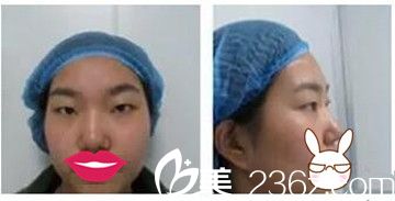 在鄭州麗天做雙眼皮手術(shù)前 在鄭州麗天做雙眼皮手術(shù)前