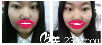 鄭州麗天做雙眼皮后12天 鄭州麗天做雙眼皮后12天