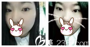 鄭州麗天雙眼皮后20天 鄭州麗天雙眼皮后20天