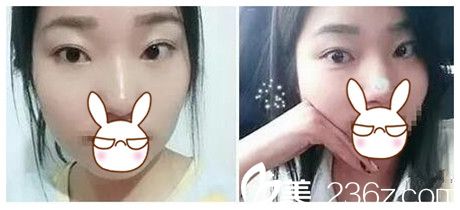 找鄭州麗天的羅明生醫(yī)生給我做了雙眼皮 術(shù)后恢復(fù)組圖