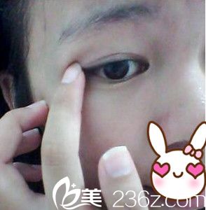 貼雙眼皮貼 貼雙眼皮貼