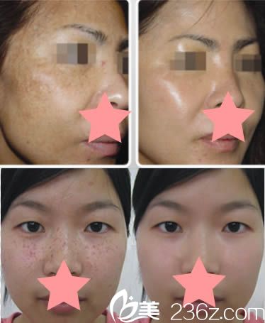 <!--<i data=20240703-sp></i>-->激光祛斑前后對比效果圖 <!--<i data=20240703-sp></i>-->激光祛斑前后對比效果圖