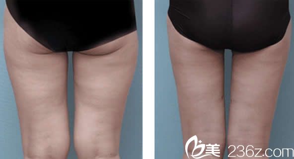 汝森李禹震腿部吸脂案例