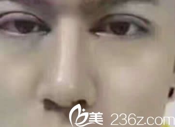 汝森楊子偉雙眼皮天