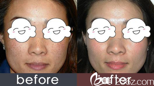 韋杰主任激光祛雀斑案例