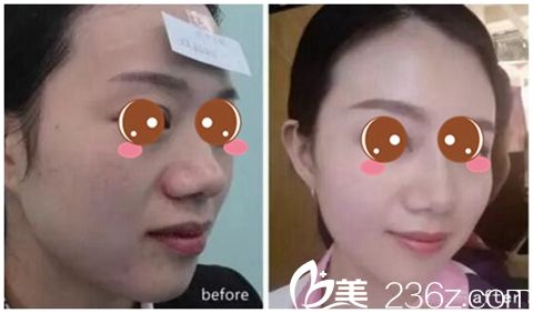 信陽(yáng)東方藝隆鼻整形 信陽(yáng)東方藝隆鼻整形