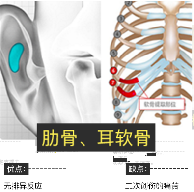 韓國(guó)肋軟骨隆鼻，好不好，多少錢(qián)