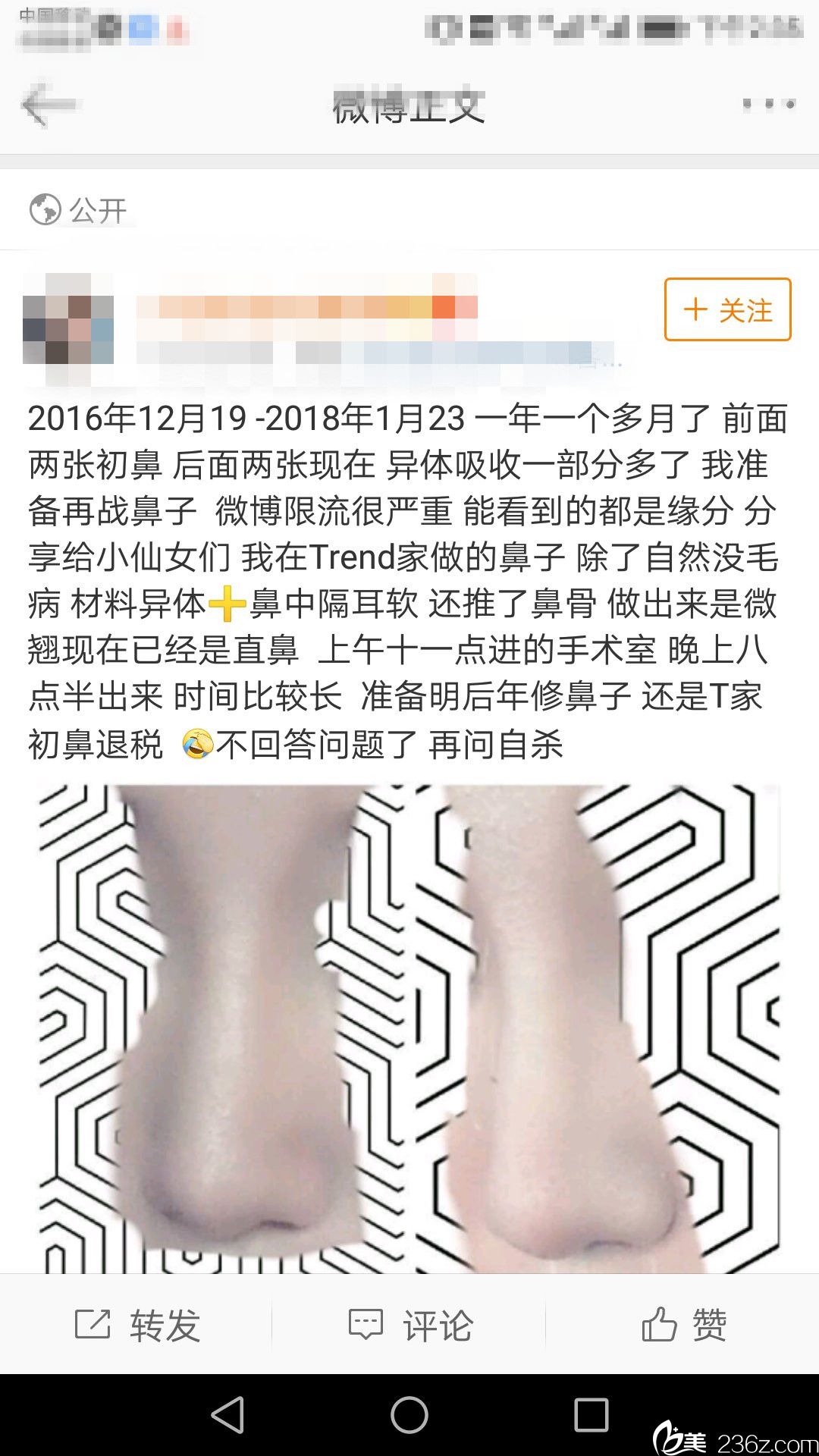 自體軟骨隆鼻，吸收了怎么辦