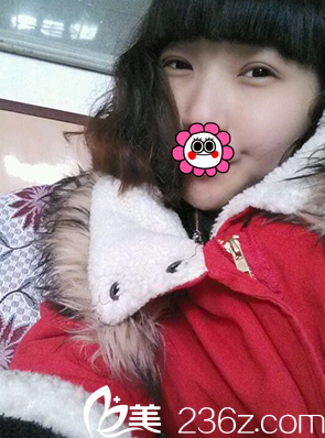 術(shù)后20天眼睛慢慢恢復(fù)中 術(shù)后20天眼睛慢慢恢復(fù)中