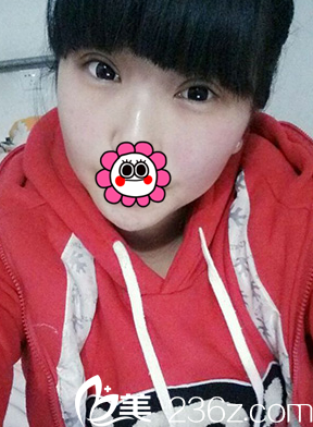 做完雙眼皮和開眼角手術(shù)15天慢慢消腫 做完雙眼皮和開眼角手術(shù)15天慢慢消腫