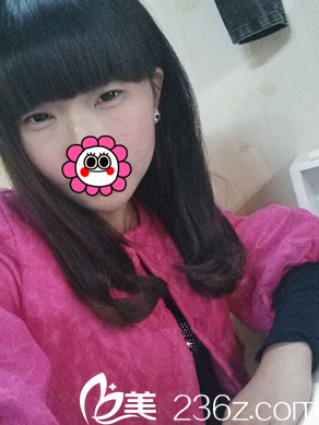 眼綜合整形前是單眼皮 眼綜合整形前是單眼皮