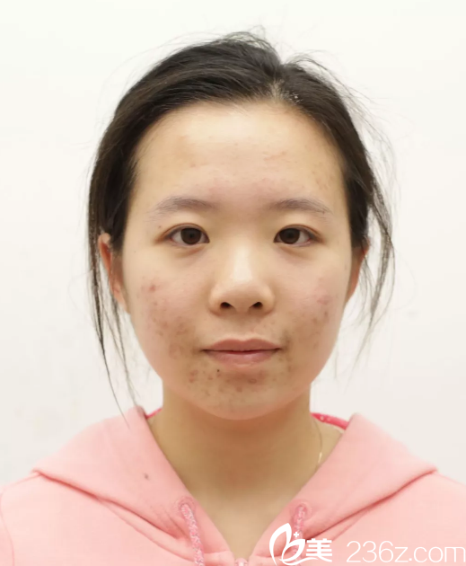 做五官整形手術(shù)前的笑笑 做五官整形手術(shù)前的笑笑