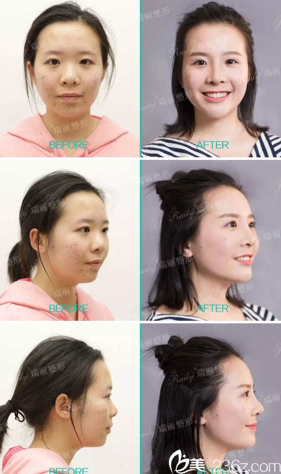 杭州瑞麗宋建良眼鼻綜合整形案例 杭州瑞麗宋建良眼鼻綜合整形案例