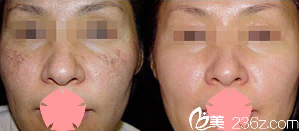 楊蓉婭激光祛斑前后對比案例 楊蓉婭激光祛斑前后對比案例