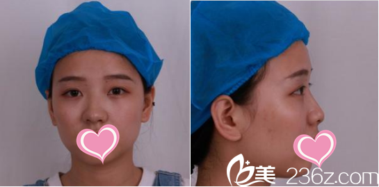 濰坊華美醫(yī)療美容醫(yī)院任傳琦醫(yī)生給我做的假體隆鼻術(shù)前圖片 濰坊華美醫(yī)療美容醫(yī)院任傳琦醫(yī)生給我做的假體隆鼻術(shù)前圖片