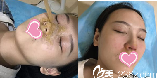 術(shù)后7天 術(shù)后7天