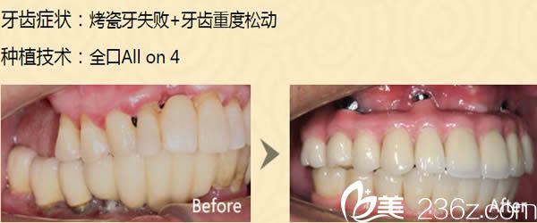 廈門華美王雪春醫(yī)生種植牙前后對比案例 廈門華美王雪春醫(yī)生種植牙前后對比案例