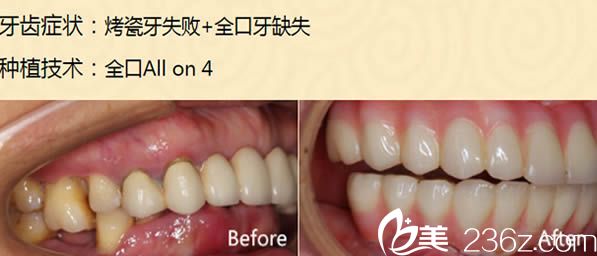 全口all on 4種植牙案例圖 全口all on 4種植牙案例圖