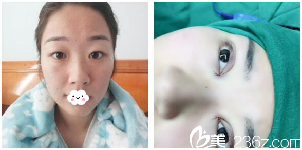 雙眼皮術(shù)前和術(shù)后即刻效果 雙眼皮術(shù)前和術(shù)后即刻效果