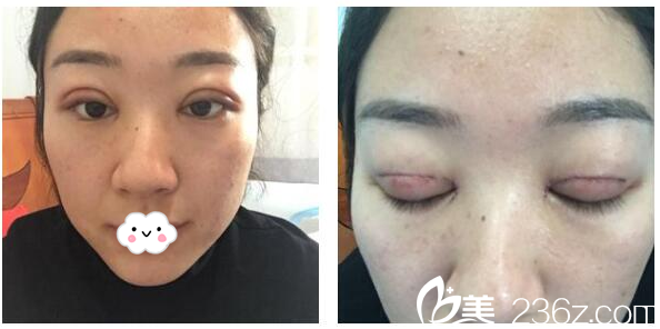 雙眼皮術(shù)后5天恢復(fù)情況 雙眼皮術(shù)后5天恢復(fù)情況