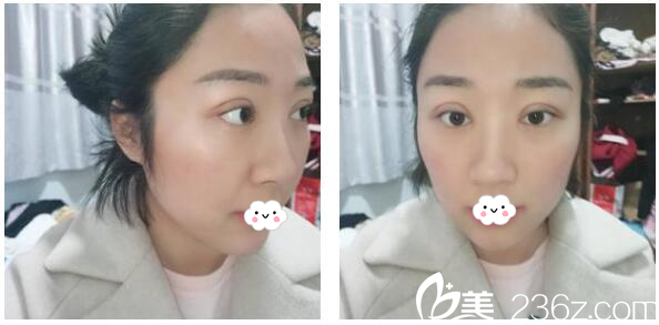 切開雙眼皮8天后的自拍 切開雙眼皮8天后的自拍