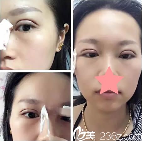 做完全切雙眼皮天的照片 做完全切雙眼皮天的照片