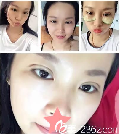 切開雙眼皮第5天恢復(fù)效果 切開雙眼皮第5天恢復(fù)效果