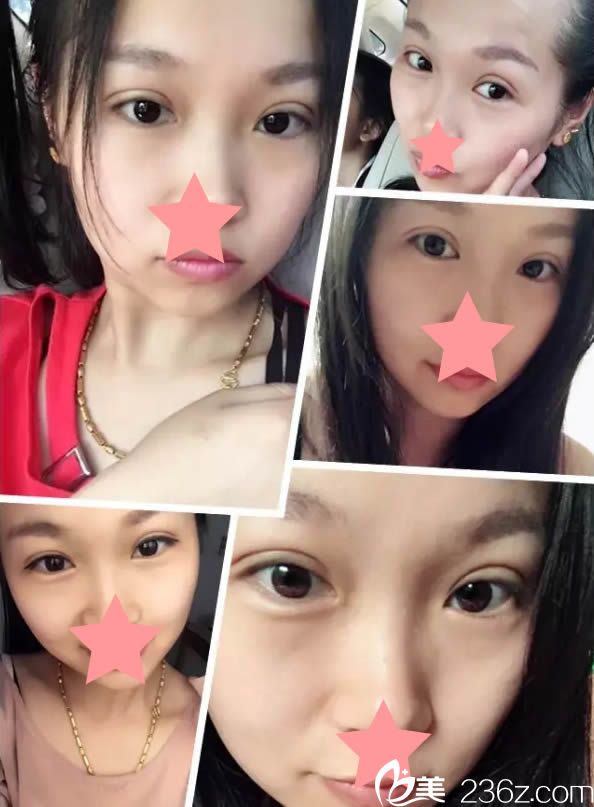 全切雙眼皮十天恢復(fù)圖 全切雙眼皮十天恢復(fù)圖