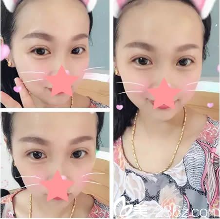 陳運生主任為我做完雙眼皮15天后的美照 陳運生主任為我做完雙眼皮15天后的美照