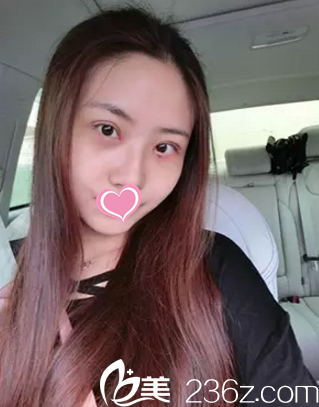 雙眼皮手術(shù)7天后拆線的樣子 雙眼皮手術(shù)7天后拆線的樣子