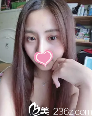 做完雙眼皮15天雙眼皮消腫不少 做完雙眼皮15天雙眼皮消腫不少