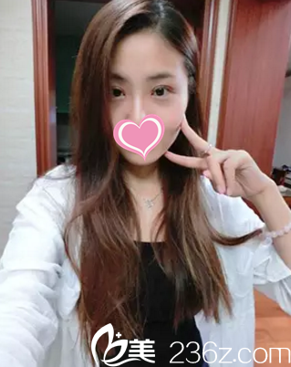 術(shù)后20天雙眼皮慢慢恢復(fù)中 術(shù)后20天雙眼皮慢慢恢復(fù)中