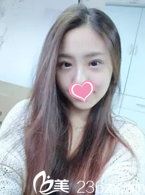 內(nèi)雙小眼睛妹紙在秦皇島念奴嬌做雙眼皮術(shù)1個月自帶放電效果