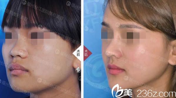 福州臺江醫(yī)院假體隆鼻案例圖