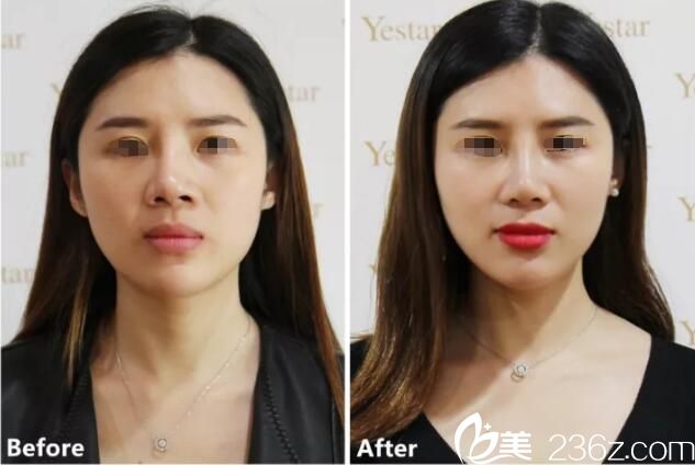 在南京藝星做隆鼻失敗修復(fù)案例