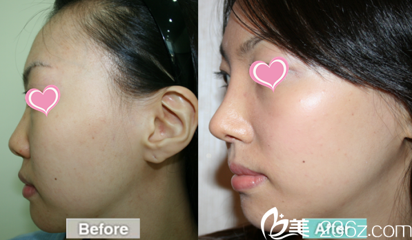 樸晙博士隆鼻案例 樸晙博士隆鼻案例