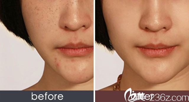 樸成哲院長(zhǎng)激光祛斑效果 樸成哲院長(zhǎng)激光祛斑效果