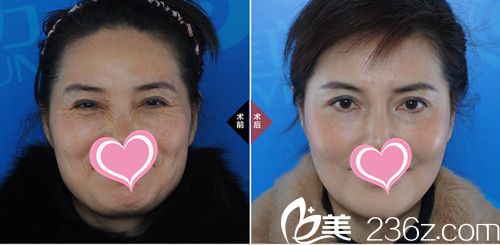 樸成哲院長(zhǎng)除皺案例 樸成哲院長(zhǎng)除皺案例