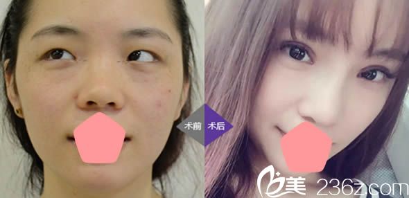 福州臺江馬美洲假體隆鼻和雙眼皮案例