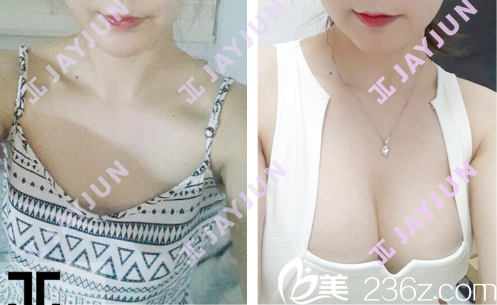 胸部整形 胸部整形