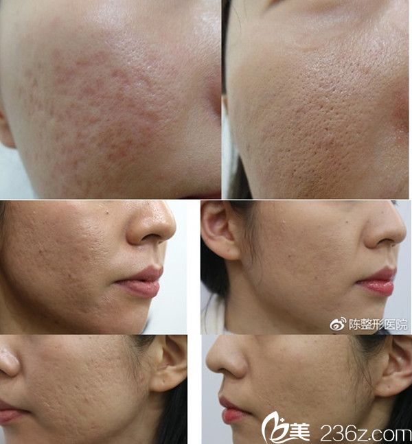 韓國(guó)陳整形外科醫(yī)院案例