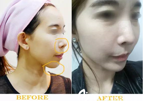 樸炯埈隆鼻加下頜角整形案例 樸炯埈隆鼻加下頜角整形案例