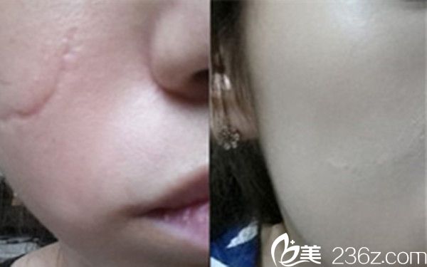 韓國陳整形外科醫(yī)院院長陳世勛祛疤痕案例 韓國陳整形外科醫(yī)院院長陳世勛祛疤痕案例