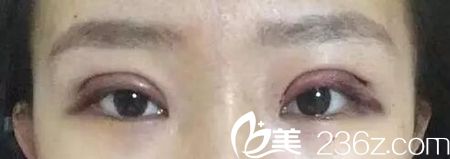 在長春圣顏做雙眼皮手術當天