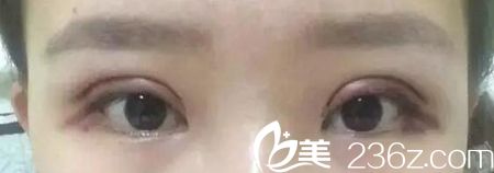 在長春圣顏做雙眼皮手術第二天